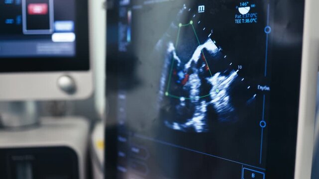 Close-up of an echocardiographic heart examination on a medical monitor. Ultrasound imaging is performed during surgery to assess the patient&rsquo;s condition.
