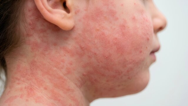 Clinical dermatology macro photo of acute confluent maculopapular measles rash on child face