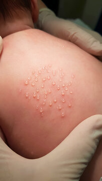 Miliaria Crystallina on Infant Skin Clinical Examination