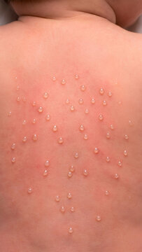 Clinical macro photo of pediatric miliaria crystallina dew drop vesicles on infant back