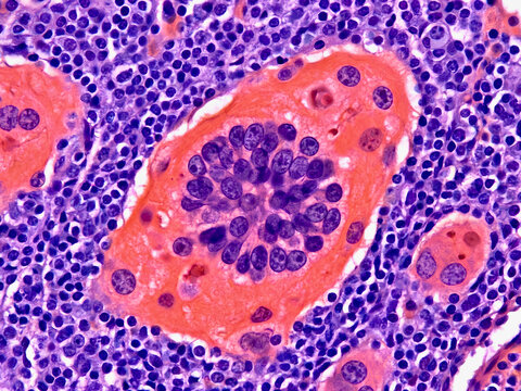 Histology of Thymus Tissue Showing Hassall's Corpuscle