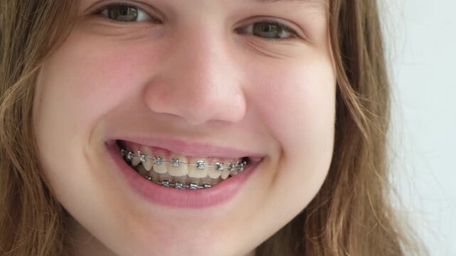Close up smile of teen girl with dental braces on teeth. Orthodontics and dentistry concept