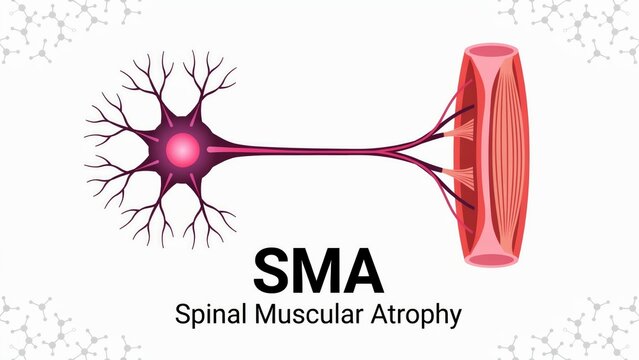 Spinal muscular atrophy, sma, diagram of a motor neuron connecting to muscle fibers