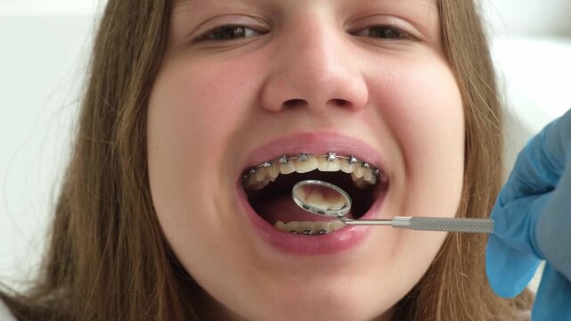Girl with dental braces visiting dentist in clinic. Doctor checks teeth with mirror. Orthodontic examination closeup. Treatment for perfect smile