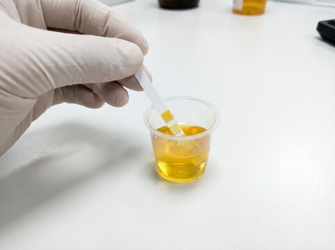 A hand wearing a medical glove holding a testing strip in a small plastic cup filled with yellow urine sample for clinical laboratory analysis
