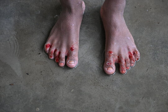 Banshkhali Upazila, Chittagong Division, Bangladesh - 09 July 2026: View of a person's feet showing visible skin lesions and sores standing on a concrete floor.
