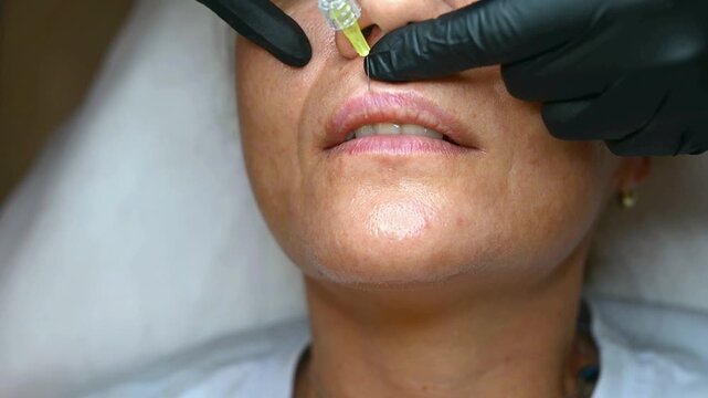 Professional lip filler injection performed by a cosmetologist. Close-up aesthetic medicine procedure for lip enhancement using hyaluronic acid in a modern beauty clinic.