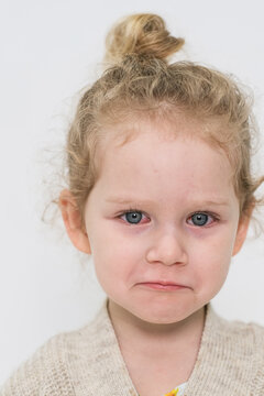 Little child with painful red eyes looking at camera. Concept of conjunctivitis or an eye infection in a kid, ophthalmology.