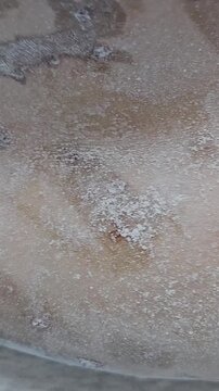 Professional removal of papillomas and moles with electrocoagulation procedure in dermatology clinic. overweight European woman on the surgical table. moles papillomas neoplasms on the body