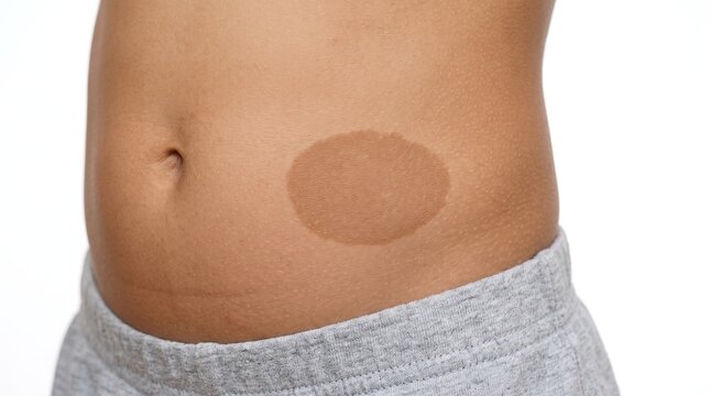 Cafe Au Lait Spot Pigmented Birthmark Macule on Kid Abdomen Skin