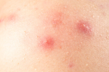 Fototapeta premium Skin rash texture with acne. Inflamed skin bumps acne macro. Close up acne on skin. Irritated acne skin.