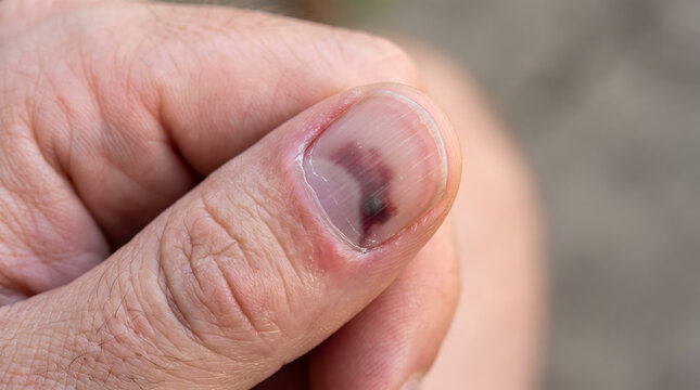 Subungual hematoma bruise under fingernail on thumb macro close up. 
AI generated.
