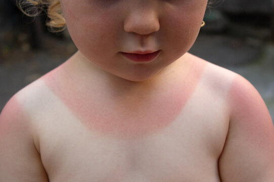Child chest sunburn redness from solar uv radiation closeup. Toddler with painful sunburned skin tan lines on shoulders for summer dermatology and sun protection concept.