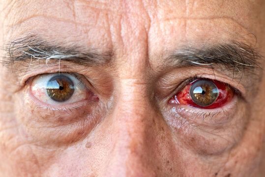 Wide-open male eyes showing subconjunctival hemorrhage (hyposphagma), visible eye hemorrhage, broken blood vessel, red eye symptom, ocular condition and ophthalmology concept