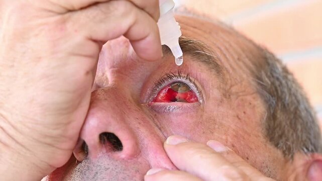 Close-up of man applying eye drops to eye with subconjunctival hemorrhage (hyposphagma), ocular treatment, red eye care, ophthalmology and vision health concept