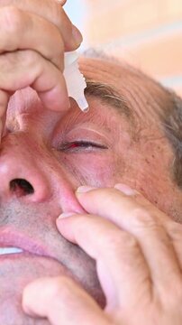 Man using ophthalmic eye drops for irritated red eye with subconjunctival hemorrhage (hyposphagma), personal eye care routine, medication use and vision health concept