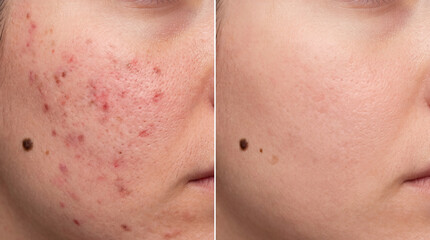 Fototapeta premium Skin comparison before and after acne treatment showing facial skin recovery from blemishes redness and scars