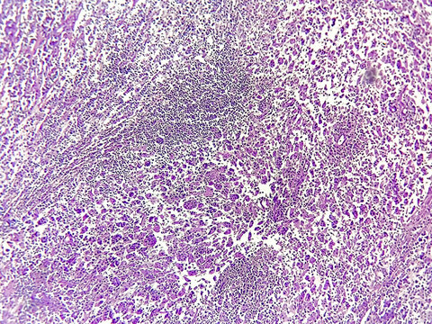 Rosai-Dorfman disease (RDD) also known as sinus histiocytosis is a rare, noncancerous disorder involving the overgrowth and accumulation of white blood cells called histiocytes.