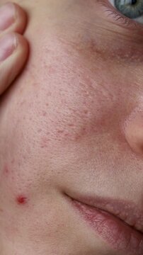 Woman showing acne scars and enlarged pores on cheek close-up - Skin texture demonstration. Realistic dermatology reference perfect for acne treatment ads, cosmetology clinic marketing a