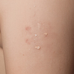 Fototapeta premium Flat Design Texture Unhealthy. Close-Up Of Unhealthy Human Skin Epidermis With Flaky And Cracked Texture