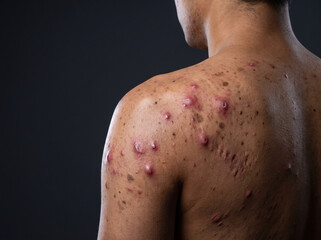 Naklejka premium Severe Nodulocystic Acne with Deep Inflamed Nodules on Adult Back and Shoulder, Chronic Acne Skin Disease Medical Stock Image