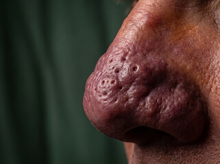 Naklejka premium Rhinophyma Thickened Bulbous Nose Skin from Advanced Rosacea, Sebaceous Hyperplasia Dermatology Medical Reference Photograph