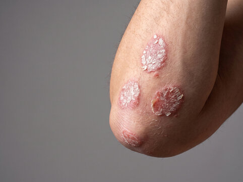 Close Up Macro of Plaque Psoriasis with Silvery Scale on Adult Elbow, Chronic Autoimmune Skin Disease Dermatology Reference Image