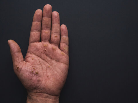 Palmoplantar Pustular Psoriasis with Sterile Yellow Pustules on Adult Palm, Chronic Inflammatory Skin Disease Macro Medical Photograph