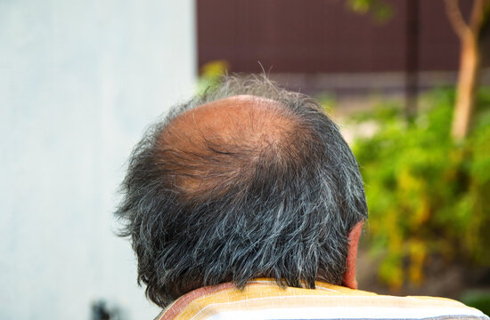 Rear view of an elderly man with thinning grey hair and a bald spot on his head outdoors. Concept of male pattern baldness, androgenetic alopecia, aging process