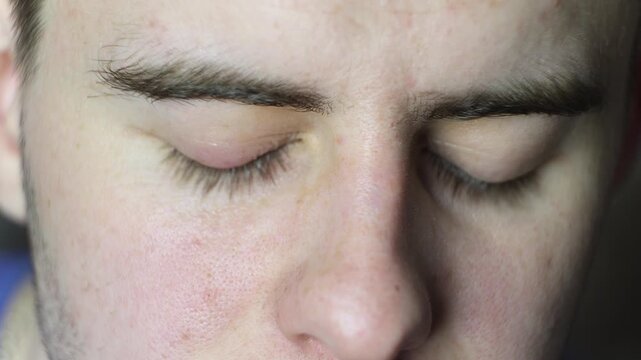 Macro Footage of Inflamed Lower Eyelid