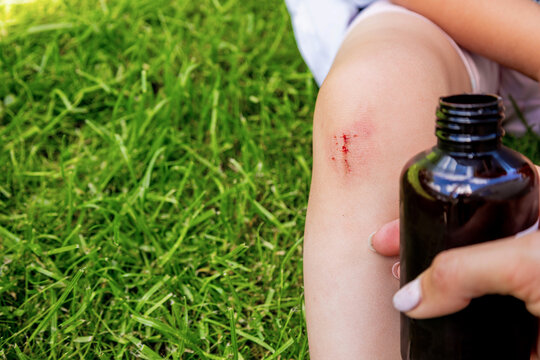 Treating child scraped knee wound with antiseptic bottle and cotton pad outdoors.