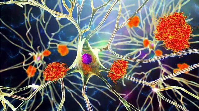 Neurons in Alzheimer&rsquo;s disease, 3D animation showing cortical nerve cells with beta-amyloid plaques and intracellular tau tangles affecting synaptic connections.