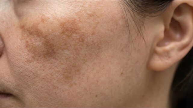 Close up of a woman face with skin pigmentation and melasma patches on her cheek