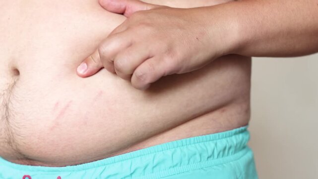 Slow motion closeup shows young man touching red stretch marks on abdomen. Visual concept for weight gain poor nutrition sugar intake and sugary drinks.