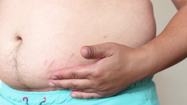Slow motion closeup shows young man touching red stretch marks on abdomen. Visual concept for weight gain poor nutrition sugar intake and sugary drinks.