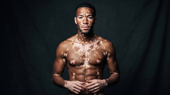 Portrait of a confident muscular Black man with vitiligo skin depigmentation on chest and face