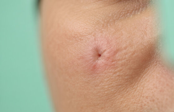 Extreme close-up macro of an epidermoid cyst with central punctum on skin