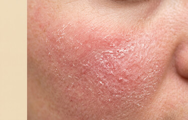 Fototapeta premium Red inflamed rash with flaking skin on cheek from rosacea or dermatitis
