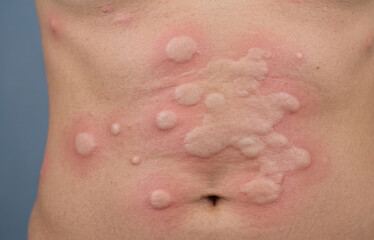 Fototapeta premium Close-up of a human torso covered in large, raised, itchy welts and hives, indicating a severe allergic reaction or urticaria.