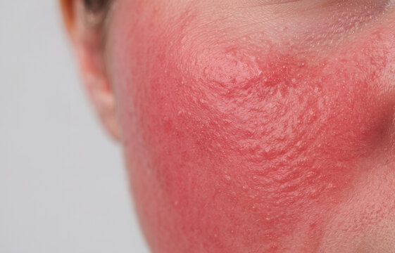 Close-up of a person's cheek showing severe facial redness, inflamed skin texture, and papules typical of rosacea or an allergic reaction.