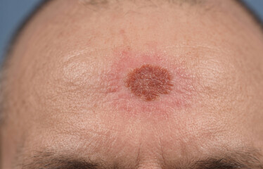 Fototapeta premium Macro close-up of a forehead showing a reddish-brown, crusty skin lesion, indicative of actinic keratosis or skin cancer development.