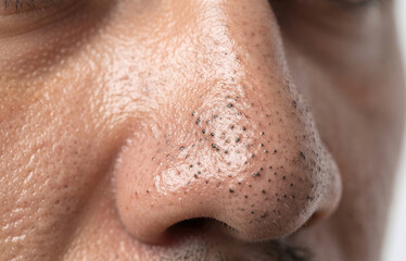 Fototapeta premium Extreme close-up of a male nose covered in numerous prominent blackheads, enlarged pores, and oily skin, highlighting dermatological issues.
