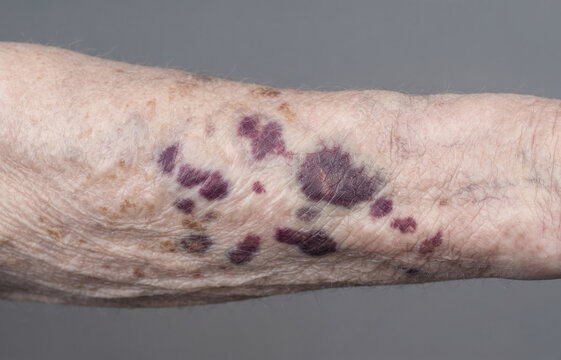 Senile purpura purple bruise spots on aging elderly arm skin