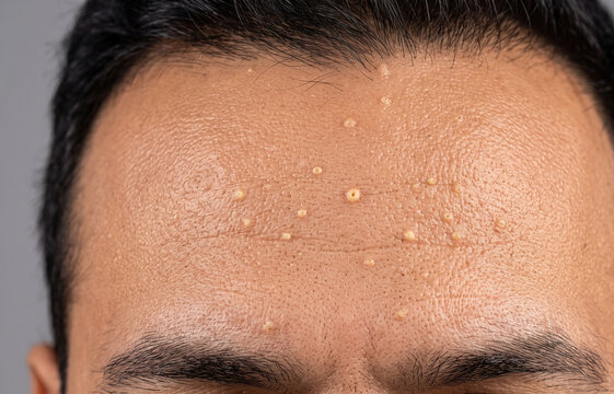 Multiple small epidermoid cysts and closed comedones on male forehead