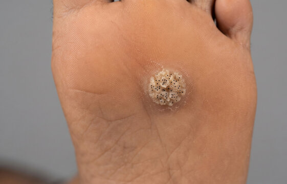 Close-up macro of plantar wart verruca plantaris with capillaries on foot sole