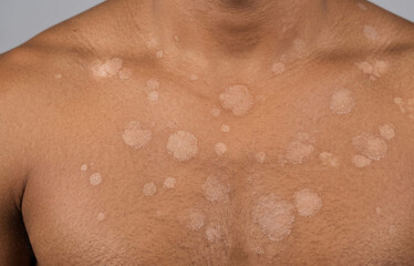 Fototapeta premium Tinea Versicolor Hypopigmentation Patches on Male Chest