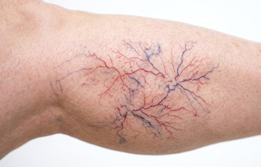 Fototapeta premium Close-up of a person's skin displaying prominent spider veins, varicose veins, and telangiectasia on the leg.