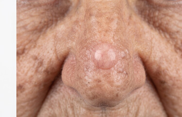Naklejka premium Close up of a smooth skin colored nodule tumor on the nose tip of an elderly patient for biopsy