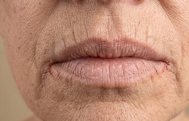 Naklejka premium Close up of dry chapped lips and angular cheilitis with painful cracks on older caucasian woman mouth