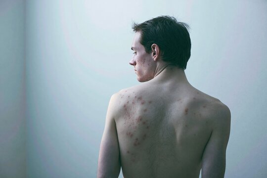 Young man with visible back acne and skin blemishes stands against a plain wall for dermatology and healthcare skincare imagery
